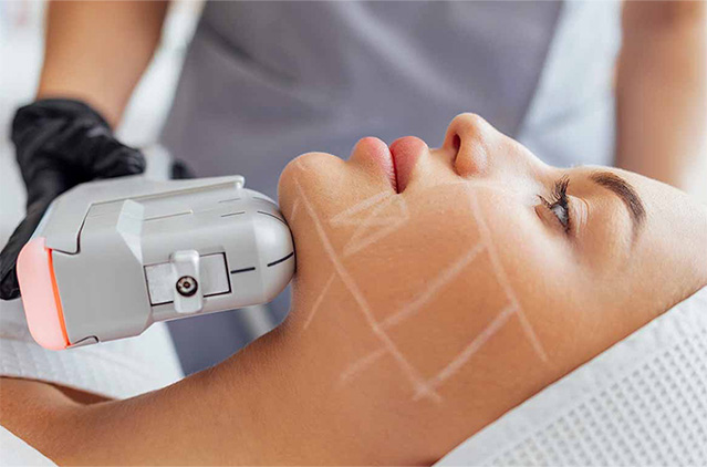 After Pico Laser